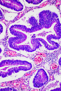 Intestinal adenomatosis
