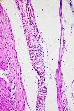 Intestinal adenomatosis