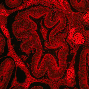 Intestinal adenomatosis