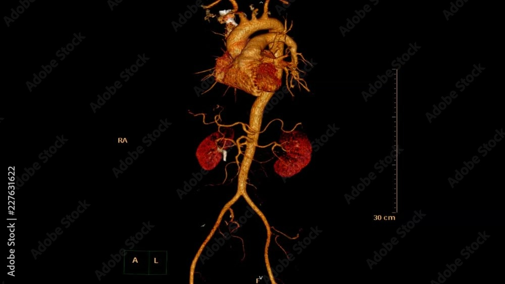 Aufkleber 3d rendering image of cta whole abdominal aorta generate from ct scanner.