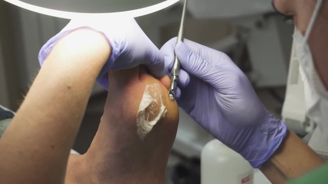 Podology treatment. Podologists using scalpel to remove a callus from customer