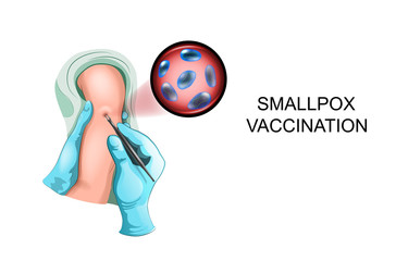 vaccinating a child against smallpox