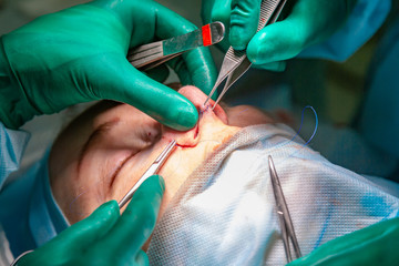 Surgeon and his assistant performing cosmetic surgery on nose in hospital operating room. Nose reshaping, augmentation. Rhinoplasty.
