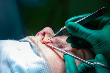 Surgeon and his assistant performing cosmetic surgery on nose in hospital operating room. Nose...