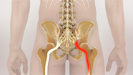 Sciatic Nerve Pain Medical Illustration
