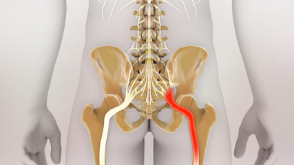 Sciatic Nerve Pain Medical Illustration