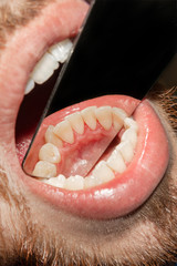 tartar close-up on the lower anterior incisors. Dental hygiene of teeth