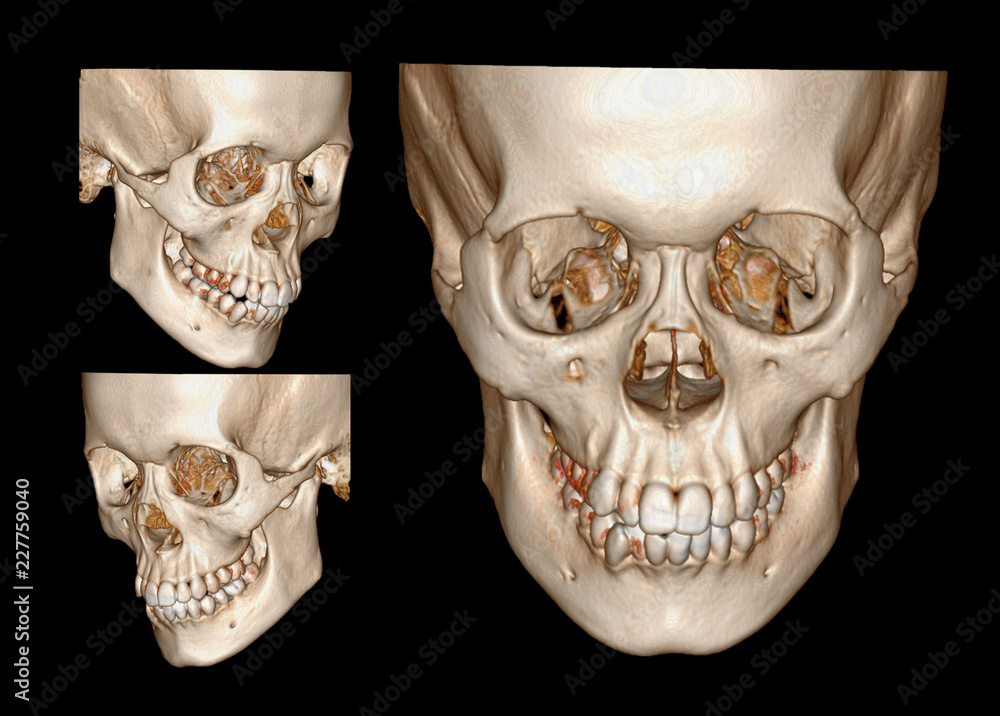 Fototapete 3d rendering image of face , facail bone ,skull front and both side view .clipping path