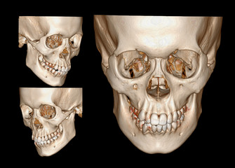 3D rendering image of Face , Facail bone ,skull front and both side view .clipping path