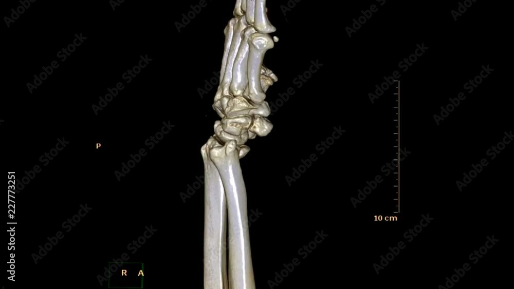 Poster ct scan of left wrist 3d rendering image rotating on the monitor . medical technology concept.