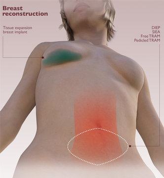 Ricostruzione del seno dopo la mastectomia, ricostruzione con protesi mammaria. Tipi diversi di ricostruzione. Donna