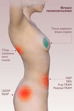 Ricostruzione del seno dopo la mastectomia, ricostruzione con protesi mammaria. Tipi diversi di ricostruzione. Donna vista di profilo