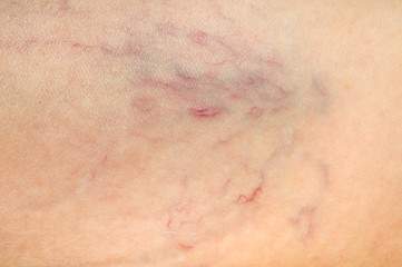 Close-up view of spider veins on female leg