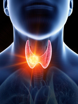 3d rendered medically accurate illustration of a mans thyroid gland cancer