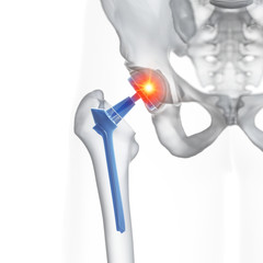 3d rendered medically accurate illustration of a hip replacement