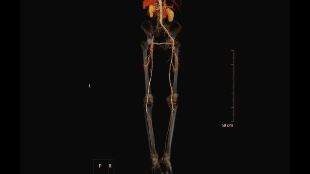 CT angiography of Lower limb with contrast media injection shown vessels 3D rendering image. CTA femural artery Run off.