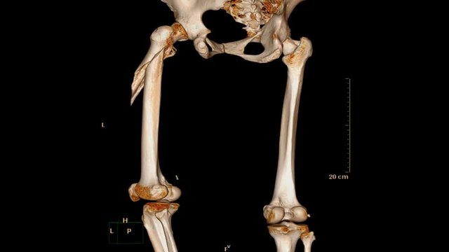 CT Scan of lower limb /pelvis /Hip joint show fracture of left femur. 