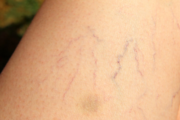 varices en la pierna de una mujer debido a la mala circulación