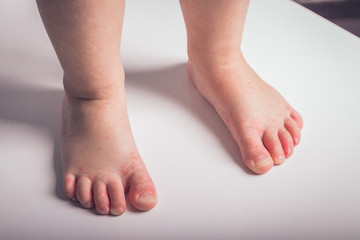illness, fever, temperature, blisters in a child's arms and feet