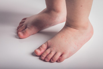 illness, fever, temperature, blisters in a child's arms and feet