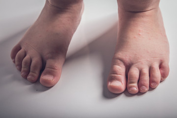 illness, fever, temperature, blisters in a child's arms and feet
