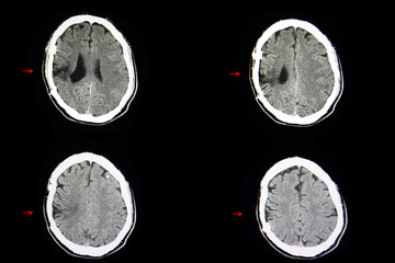 CT scan cerebro malacia