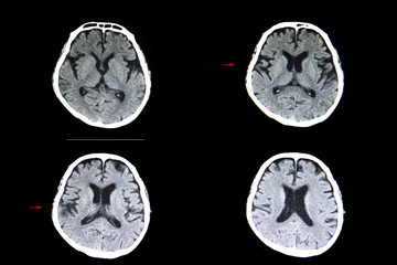 brain atrophy and cerebral infarction