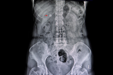 calcified gall bladder stone