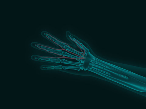 X-ray of a human hand with carpal tunnel syndrome 3d render medical illustration
