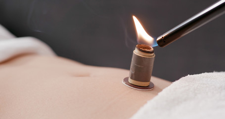 Chinese medicine moxibustion therapy
