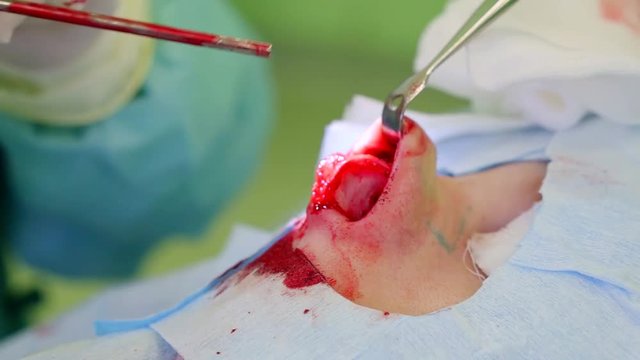 surgeons are correcting the nasal septum for patient of medical clinic, close-up