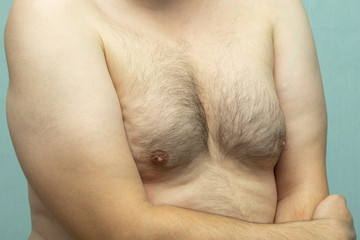 Naklejka premium fat white middle-aged man with Gynecomastia, enlarged breast