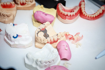 various samples of casts of dentures, close up