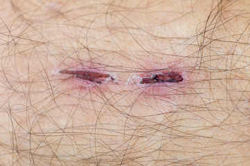 sore skin wound
