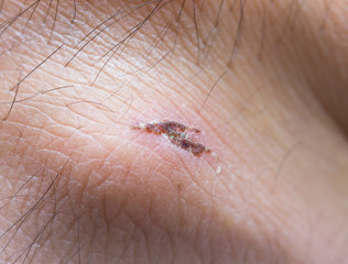 sore skin wound