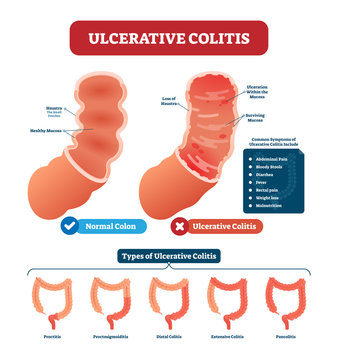 Ulcerative colitis vector illustration. Labeled anatomical infographic