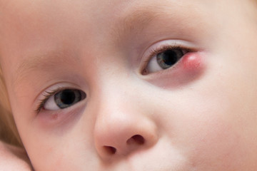 child's eye suffers from ailment