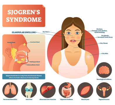 Sjogrens syndrome vector illustration. Dry body autoimmune disease.