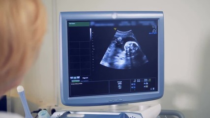 Sonography monitor with an image of a fetus. Medical ultrasound scan.