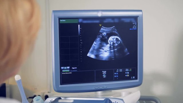 Sonography monitor with an image of a fetus. Medical ultrasound scan.