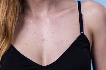 Woman having pimples red spots on chest