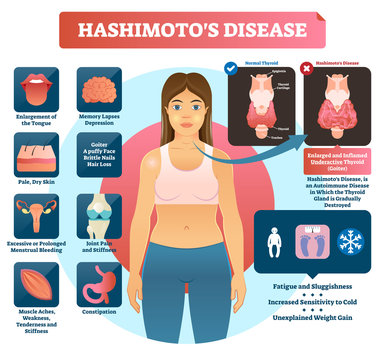 Hashimotos thyroiditis vector illustration. Labeled medical diagram.