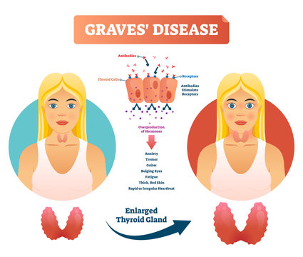 Graves disease vector illustration. Labeled diagnosis symptoms diagram