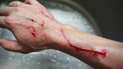 Scratch and Blood on arm after a man try to catch a domestic cat on the road, man's  arm placed on a board with a long slice/cut/wound going across it with blood on it drying up, Healthcare conceptual