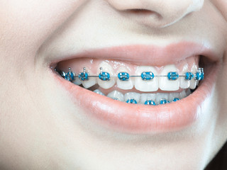 Woman showing her teeth with braces