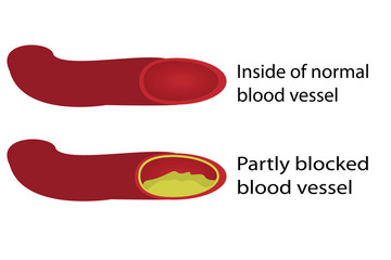Healthy and blocked blood vessels illustration