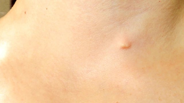 Defect on the skin, pinch