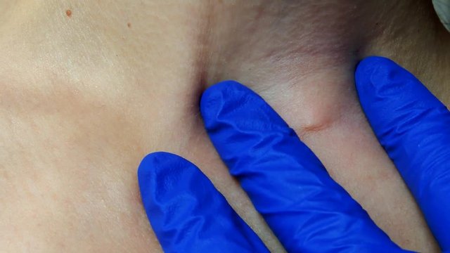 Defect on the skin, pinch