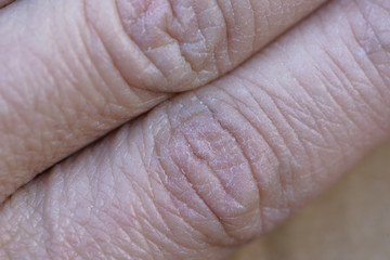 The problem with many people - eczema on hand.