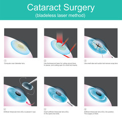 Cataract Surgery. The use of medical lasers to cutting eye lens in small pieces and suction out, in order to use artificial lenses, because the symptoms are cataracts.
 - obrazy, fototapety, plakaty
